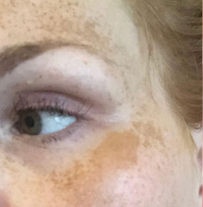 Ipl treatment for pigmentation deals