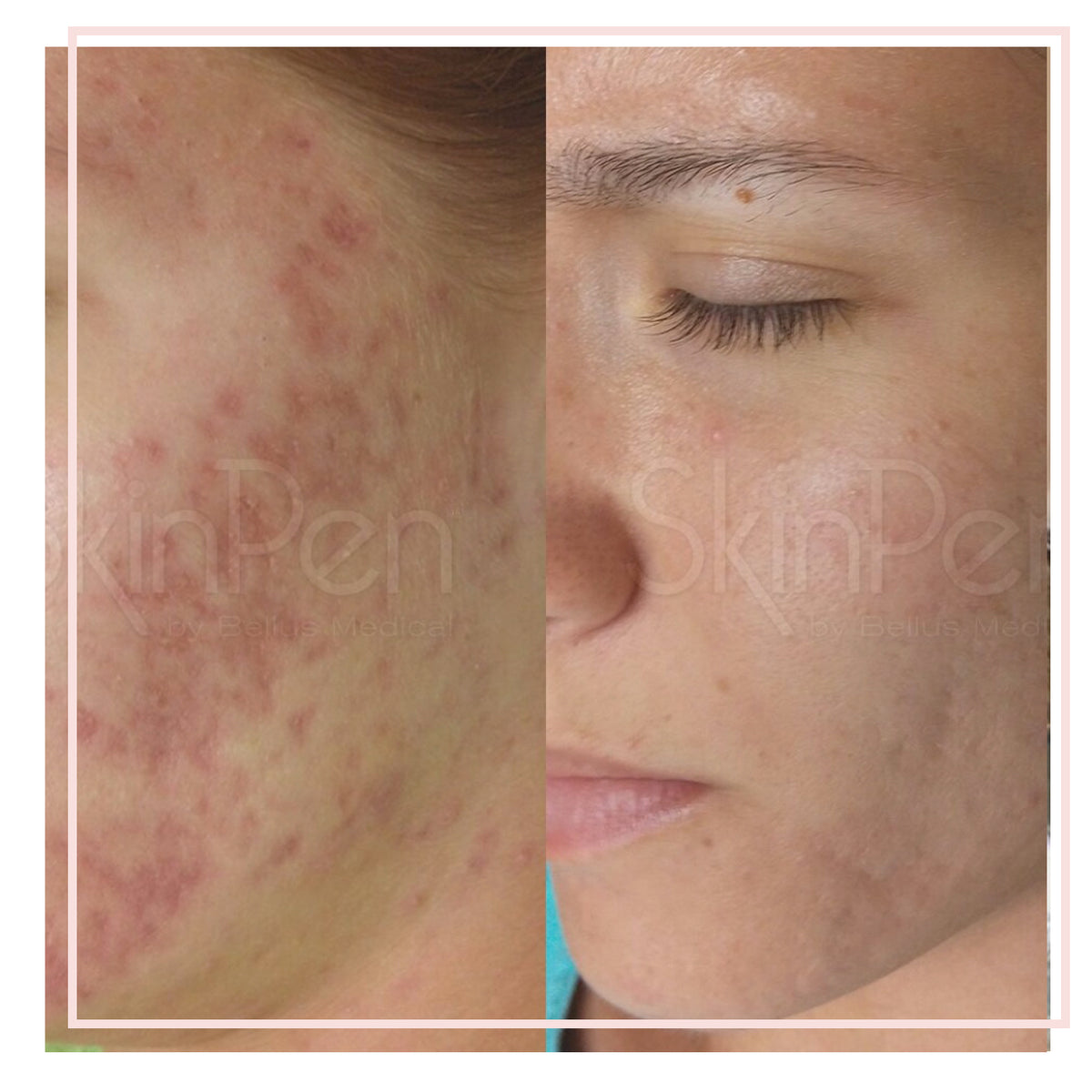 Skinpen microneedling therapy