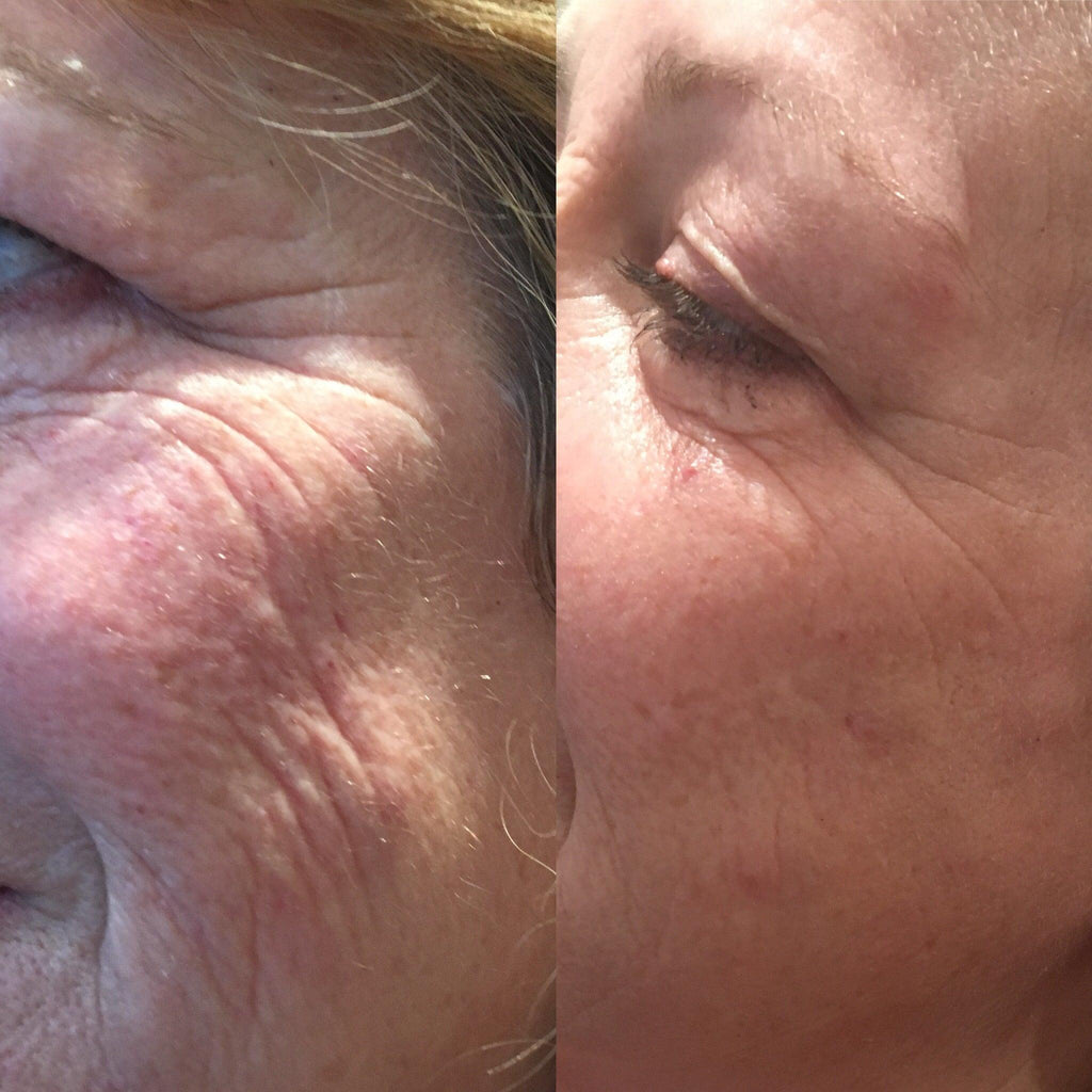 The Eight Point Lift (Full Facial Rejuvenation) - Image #4