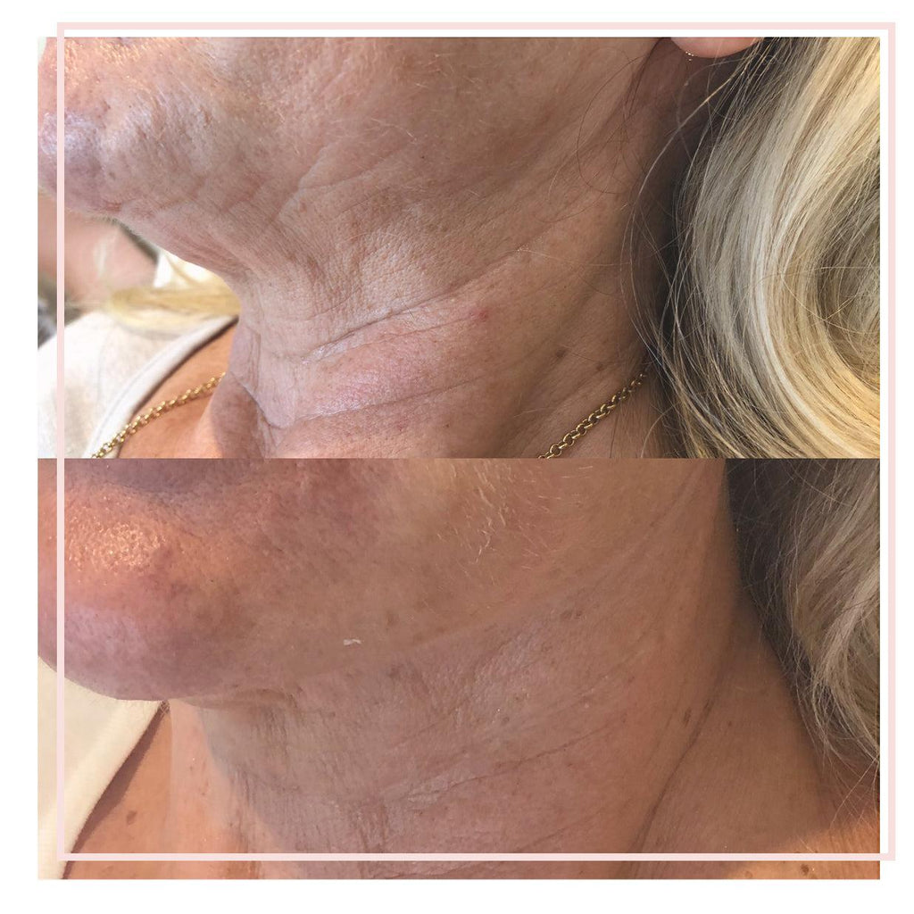 Neck Treatment Packages - Emma Coleman Skin
