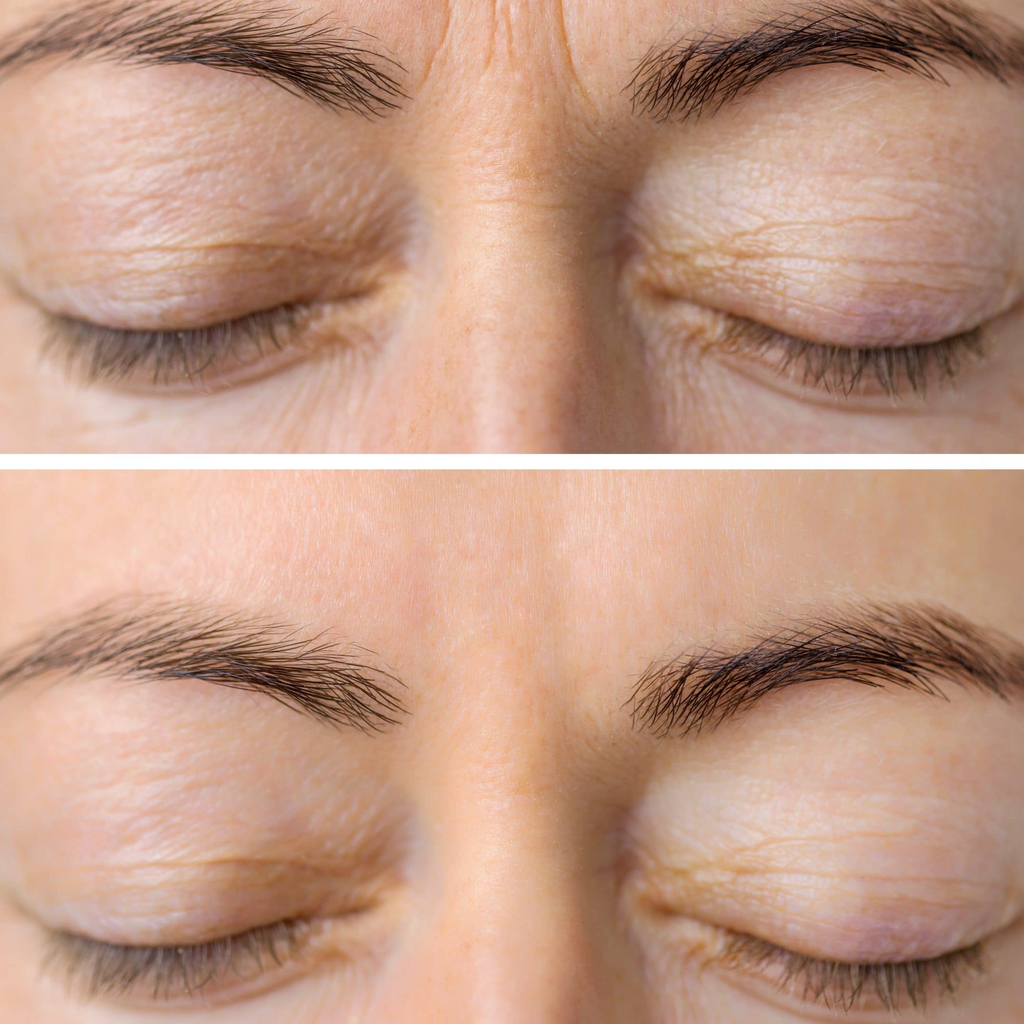 CAN BOTOX MAKE YOUR EYELIDS HEAVY?