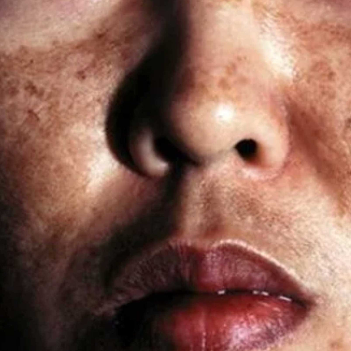 Hyperchromic Rash Hemochromatosis Skin Rash