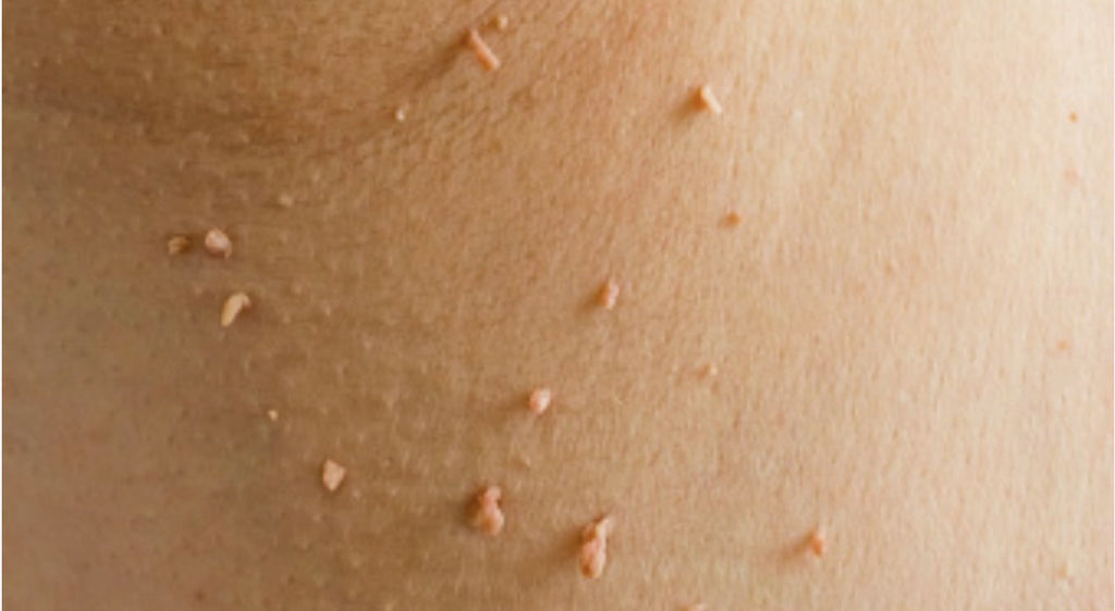 Skin Tags and The Menopause