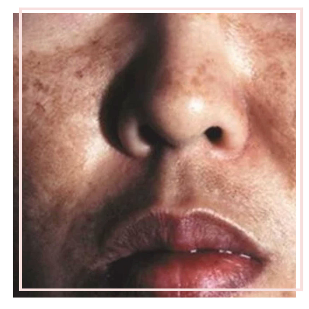 HYPER-PIGMENTATION AND MELASMA: THE FACTS ABOUT  EFFECTIVE TREATMENT AND REDUCTION