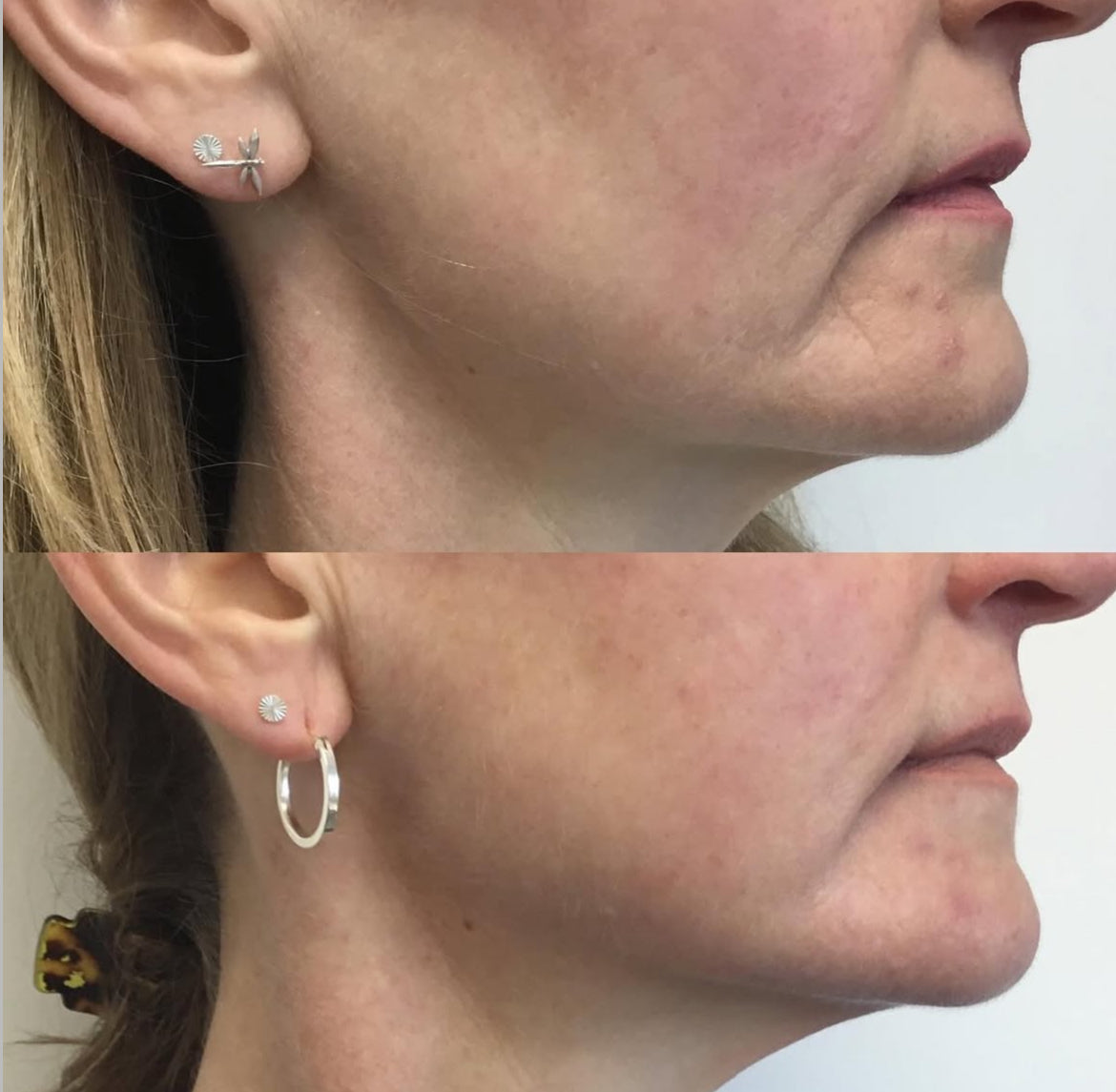 Thread Lift by Emma Coleman Skin
