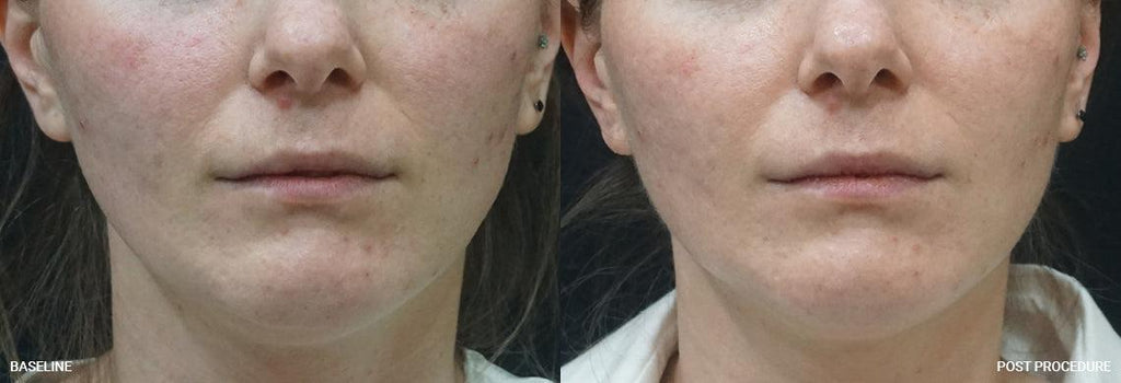 This image shows a before and after of a client who has received a Morpheus 8 treatment for skin tightening, skin rejuvenation, and anti-aging at our Beckenham dermatology clinic. We service clients from across Kent including Sevenoaks, Orpington, Petts Wood, and Bromley and Beckenham in Greater London.