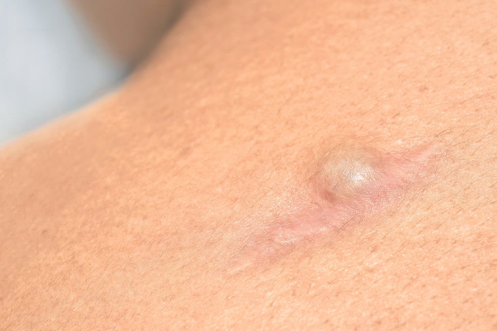 This image represents the services we provide for cyst and lipoma removal at our QCQ regulated dermatology and skin cancer clinic in Petts Wood, Kent. treating clients across Kent and Greater London including Brockley, Beckenham, Petts Wood, Sevenoaks, and Orpington.