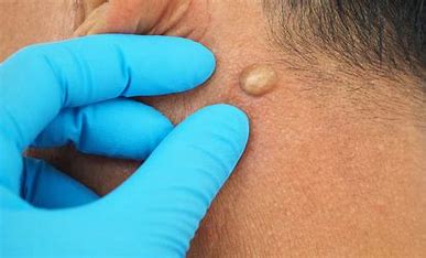 This image represents our service of cyst and lipoma removal which is available at our dermatology and skin cancer clinic here in Petts Wood, Kent. If you need any help with diagnosis of a cyst or lipoma, don't hesitate to contact us.