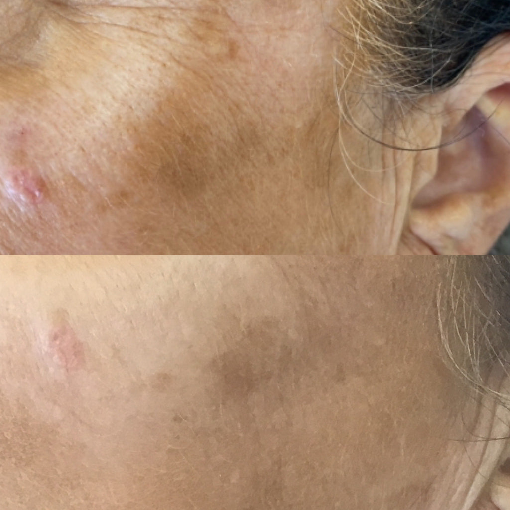 This image demonstrates mole, milia, or other lesion removal at our dermatology clinic in Beckenham. We serve patients from across Kent and Greater London including Petts Wood, Bromley, Sevenoaks, and Orpington.
