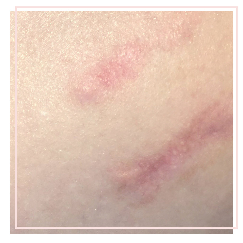 Scarring Rashes Dermatology