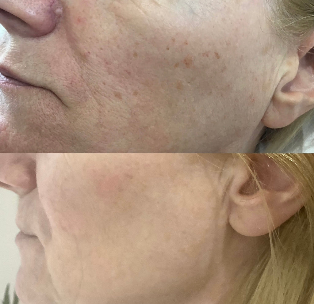 This image demonstrates mole, milia, or other lesion removal at our dermatology clinic in Beckenham. We serve patients from across Kent and Greater London including Petts Wood, Bromley, Sevenoaks, and Orpington.
