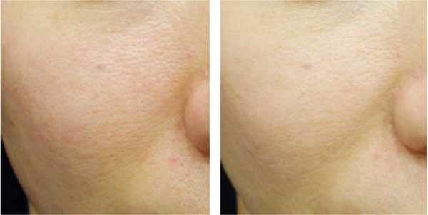 This image shows a before and after of a client who has received a Morpheus 8 treatment for skin tightening, skin rejuvenation, and anti-aging at our Beckenham dermatology clinic. We service clients from across Kent including Sevenoaks, Orpington, Petts Wood, and Bromley and Beckenham in Greater London.