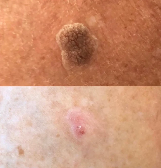 Mole removal