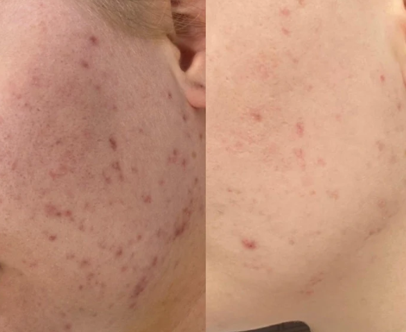 Laser Skin Rejuvenation