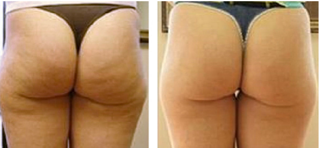Fat Freezing, Skin Tightening and Cellulite Reduction