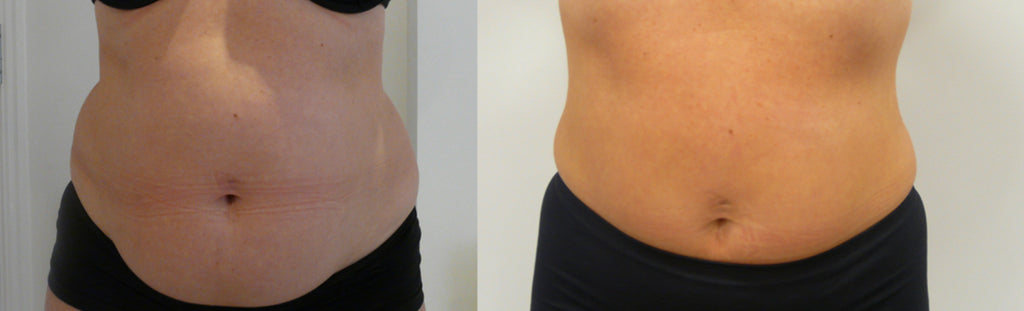 Radiofrequency Face and Body Tightening