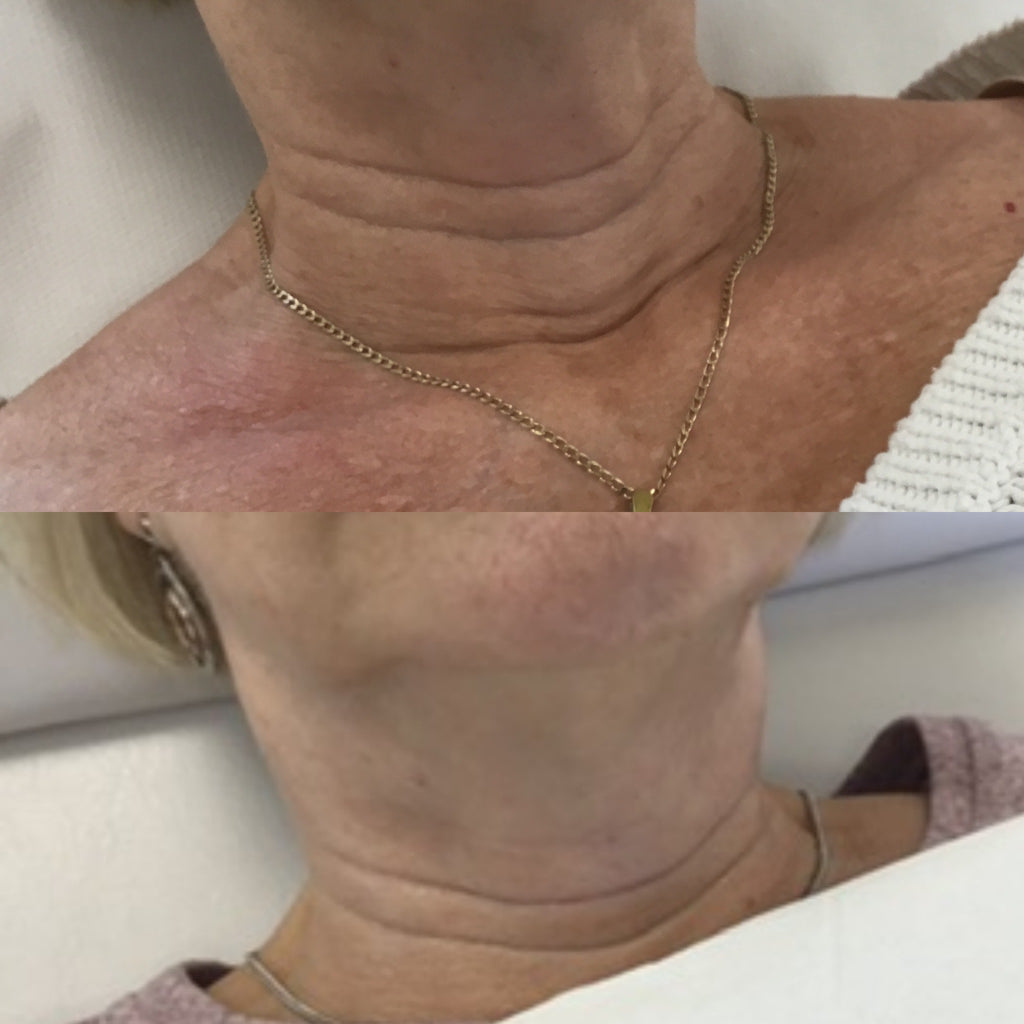 Neck Treatment Packages