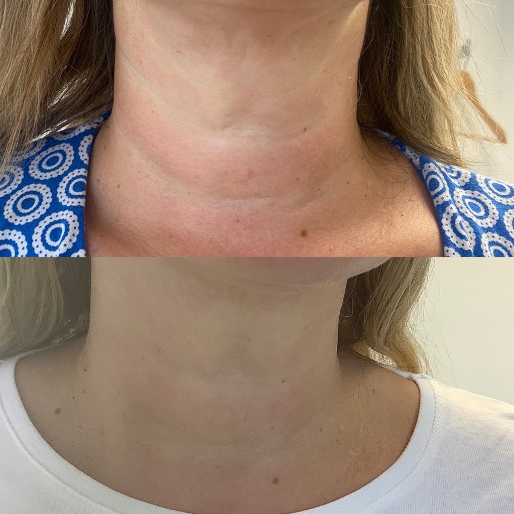 Neck Treatment Packages - Emma Coleman Skin