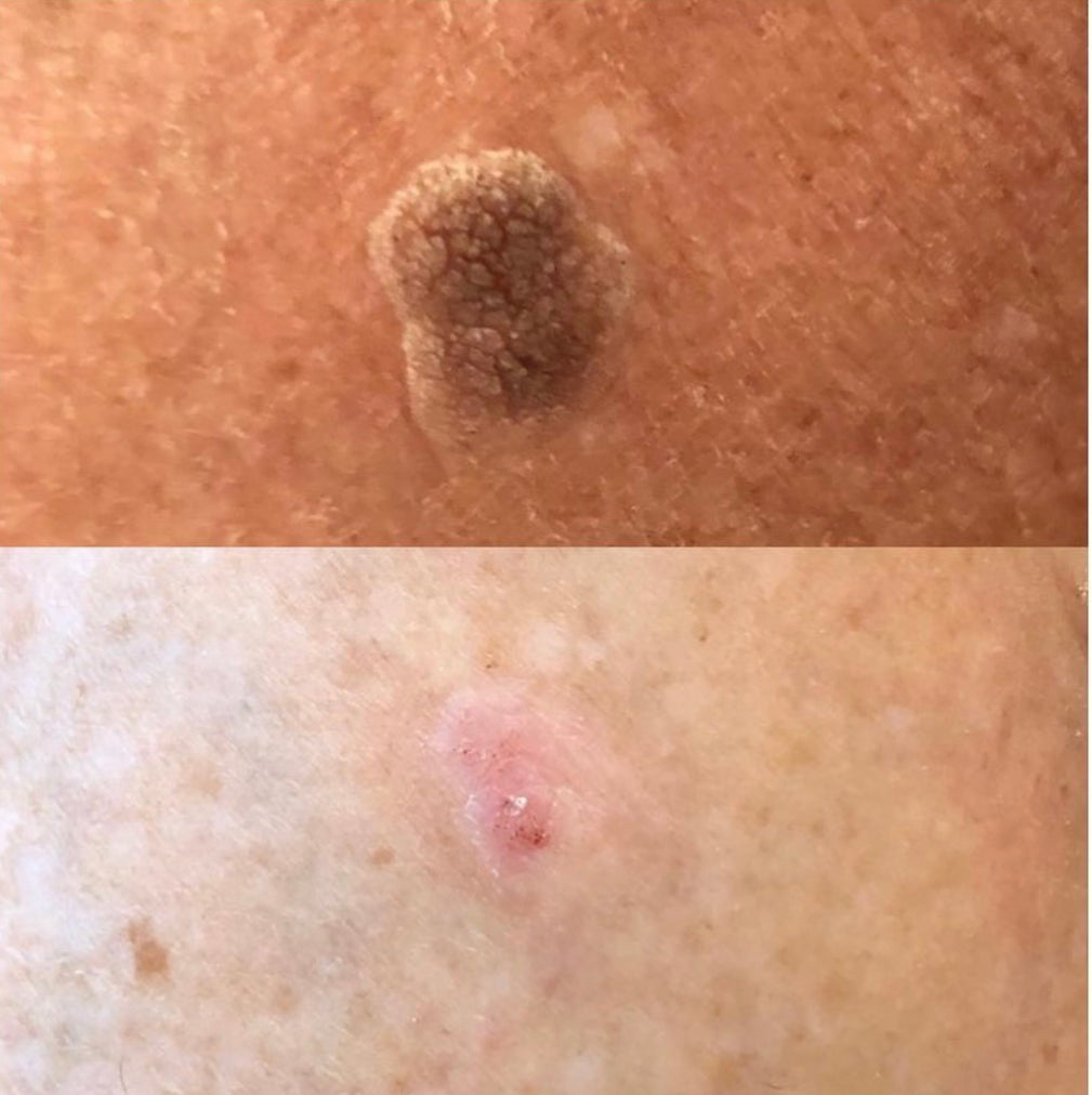 This image demonstrates mole, milia, or other lesion removal at our dermatology clinic in Beckenham. We serve patients from across Kent and Greater London including Petts Wood, Bromley, Sevenoaks, and Orpington.
