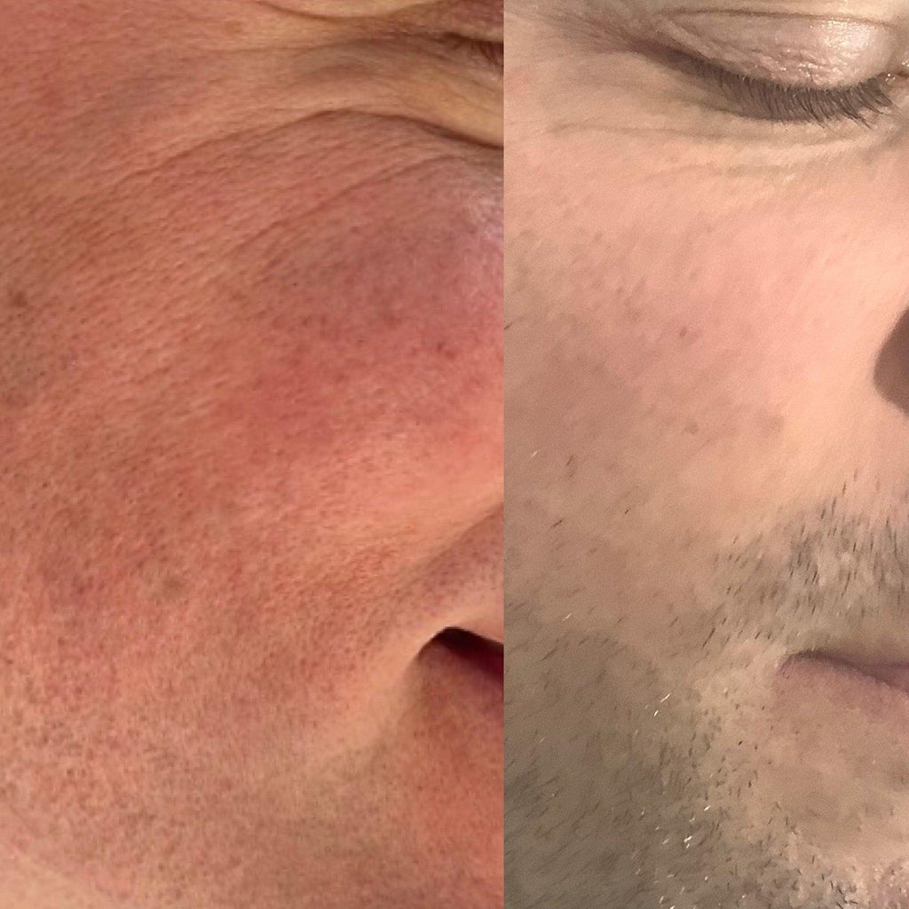 This image shows a before and after of a IPL Facial Thread Vein Treatment at Emma Coleman Skin's dermatology clinics in Orpington, Bromley, Sevenoaks, Petts Wood and Beckenham.