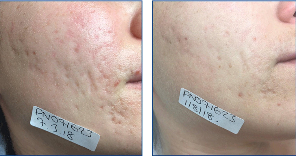 Before and after Fractional Laser Resurfacing treatment at Bromley and Petts Wood laser clinic, showing reduction in acne scars, pigmentation, and fine lines, with tighter pores and smoother, rejuvenated skin on the face and neck.