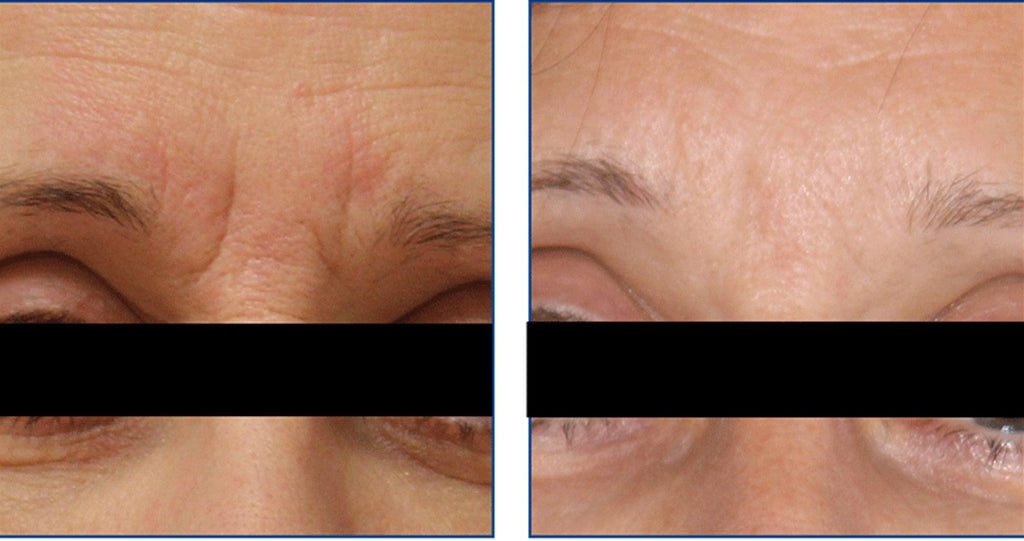 Before and after Fractional Laser Resurfacing treatment at Bromley and Petts Wood laser clinic, showing reduction in acne scars, pigmentation, and fine lines, with tighter pores and smoother, rejuvenated skin on the face and neck.