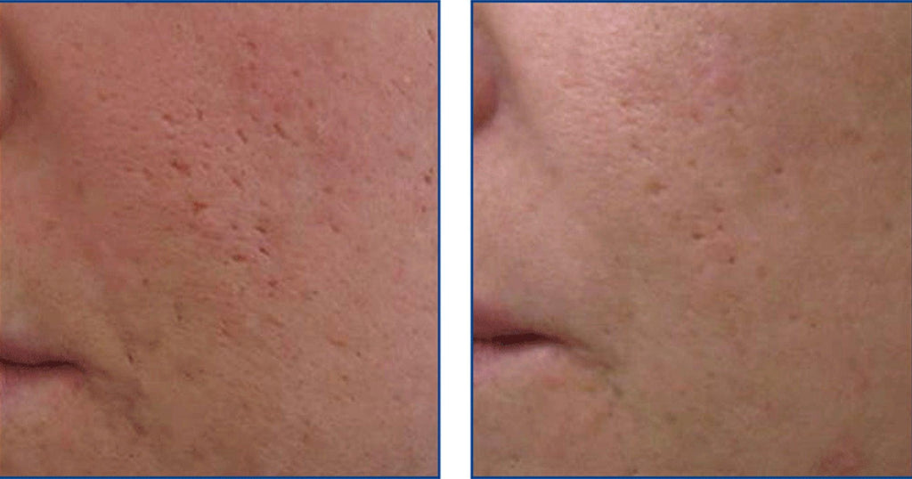 Before and after Fractional Laser Resurfacing treatment at Bromley and Petts Wood laser clinic, showing reduction in acne scars, pigmentation, and fine lines, with tighter pores and smoother, rejuvenated skin on the face and neck.