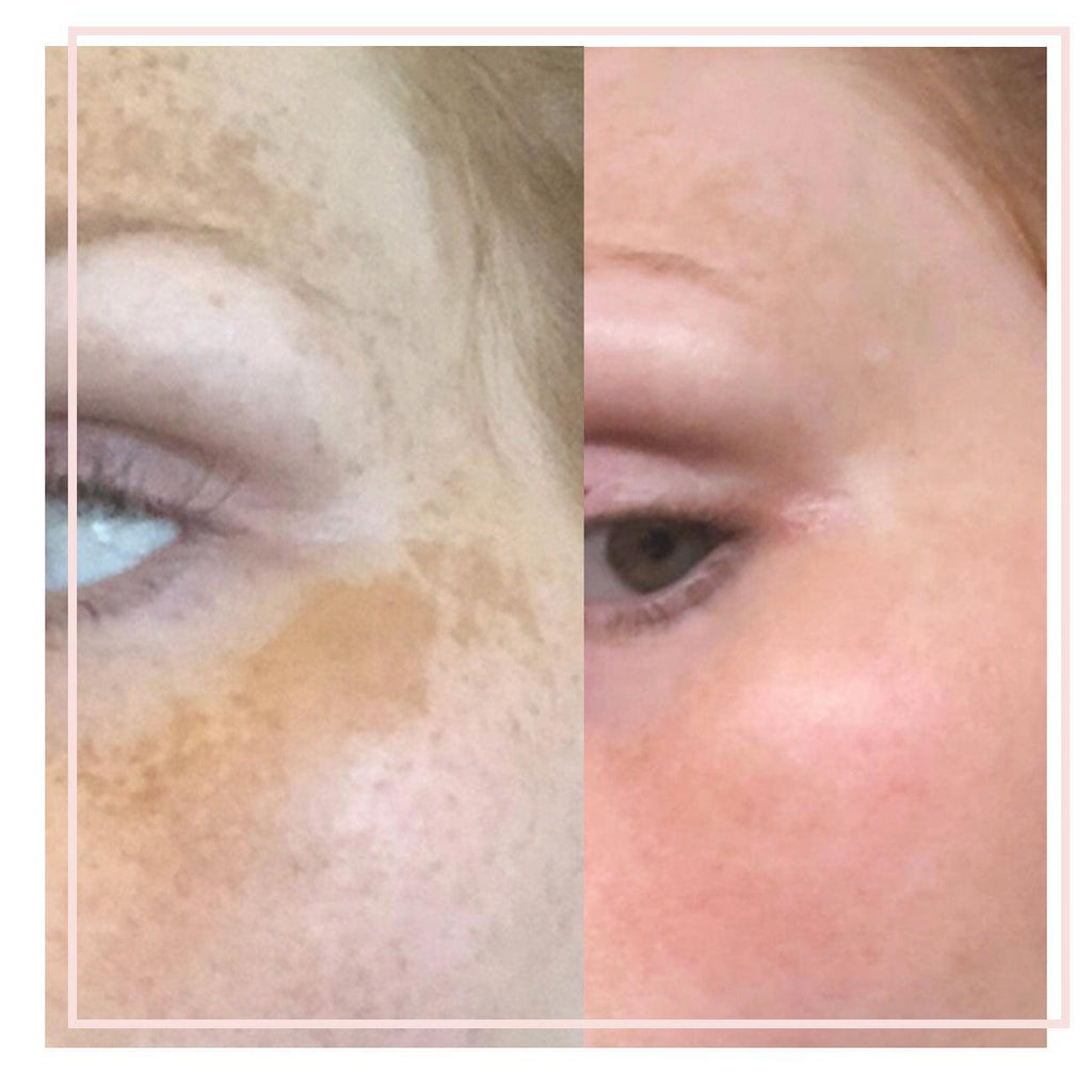 This image shows a before and after image of IPL treatments for hyperpigmentation and melasma carried out at Emma Coleman Skin's dermatology clinics in Beckenham, Petts Wood, Orpington, Sevenoaks and Bromley.