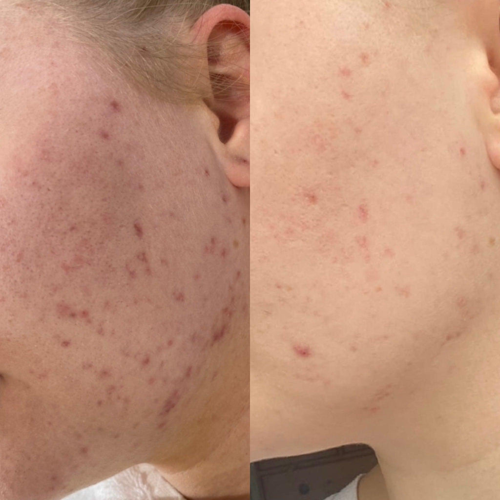 Before and after IPL and ND YAG Laser skin rejuvenation treatment in Bromley clinic, showing reduction in dark spots, tighter pores, smoother wrinkles, and restored skin elasticity on face and neck.