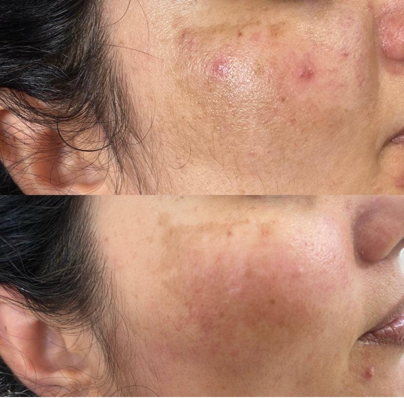 This image shows a before and after image of IPL treatments for hyperpigmentation and melasma carried out at Emma Coleman Skin's dermatology clinics in Beckenham, Petts Wood, Orpington, Sevenoaks and Bromley.