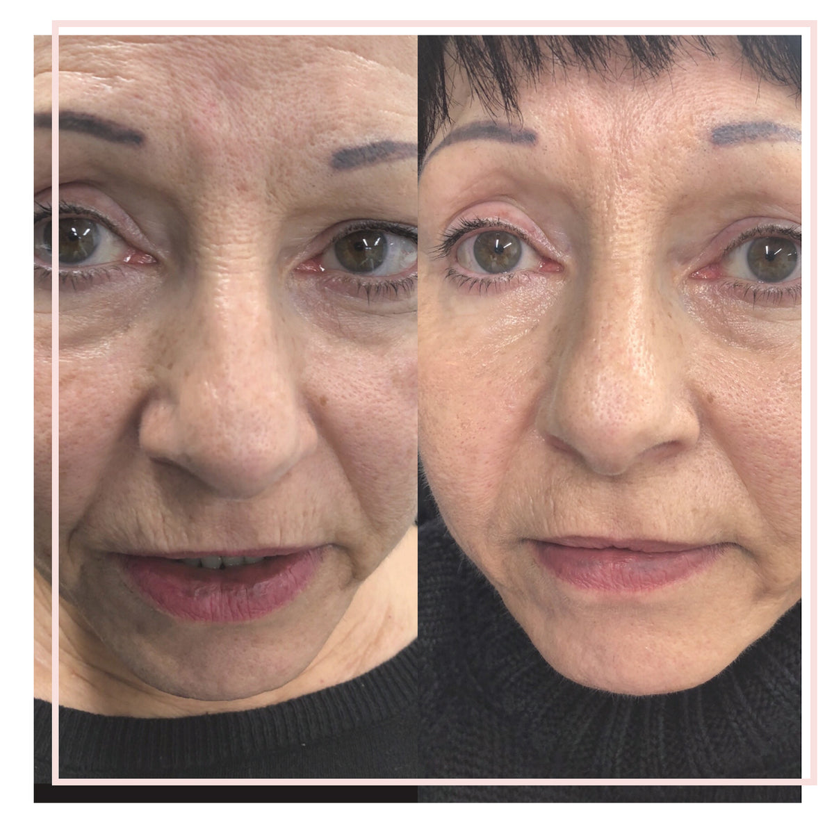 HarmonyCa- full face rejuvenation by Emma Coleman Skin