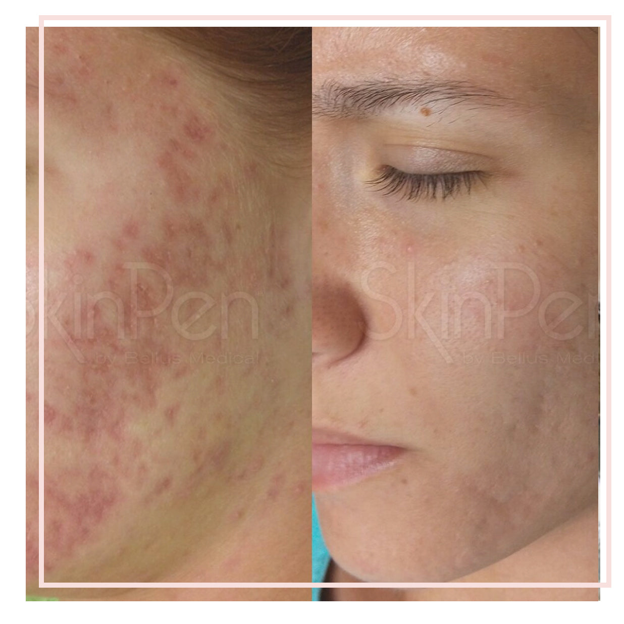 Skinpen microneedling therapy