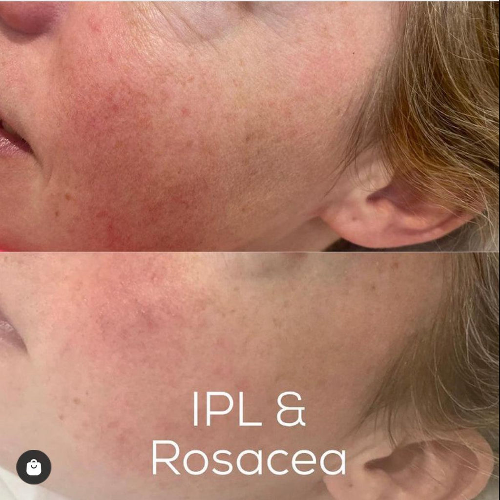 This image shows a before and after of a IPL Facial Thread Vein and Rosacea Treatment at Emma Coleman Skin's dermatology clinics in Orpington, Bromley, Sevenoaks, Petts Wood and Beckenham.