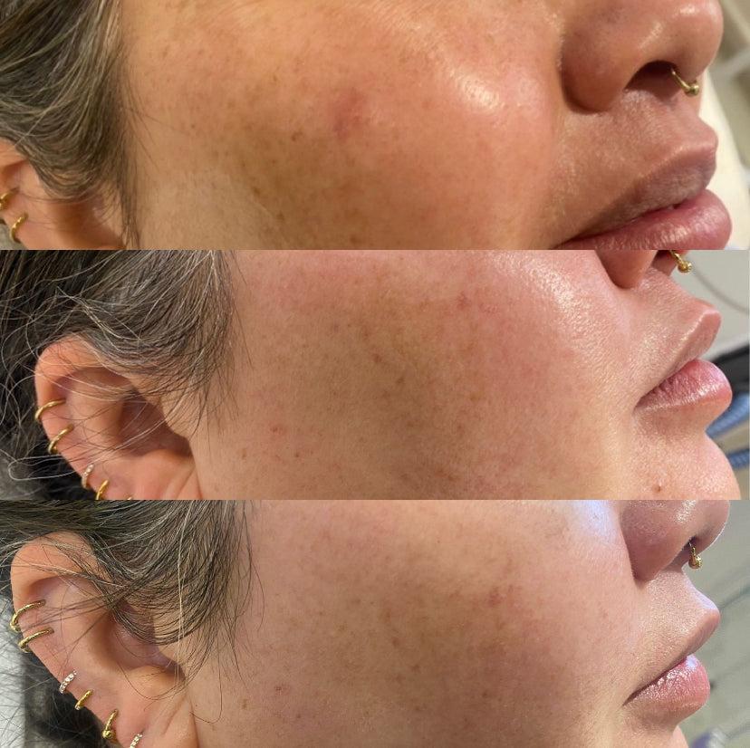 This image shows a before and after image of IPL treatments for hyperpigmentation and melasma carried out at Emma Coleman Skin's dermatology clinics in Beckenham, Petts Wood, Orpington, Sevenoaks and Bromley.