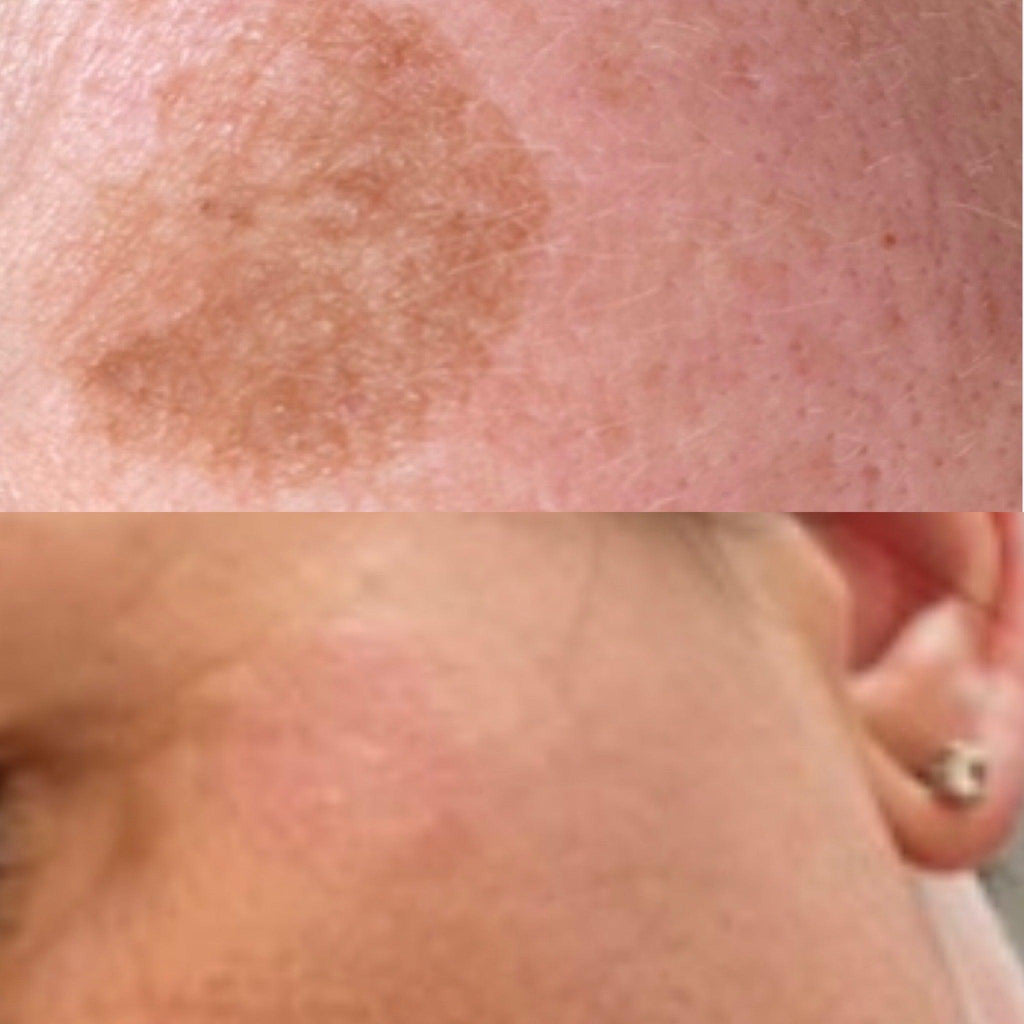 This image demonstrates a before and after of mole, milia, or other lesion removal at our dermatology clinic in Beckenham. We serve patients from across Kent and Greater London including Petts Wood, Bromley, Sevenoaks, and Orpington.