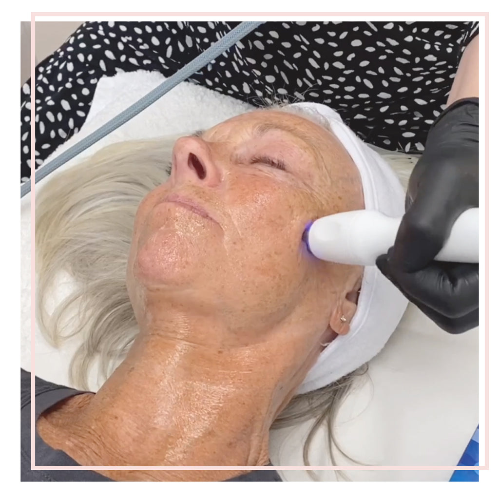Radiofrequency Face and Body Tightening