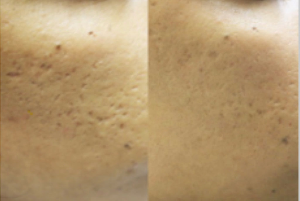 Skinpen microneedling therapy - Emma Coleman Skin