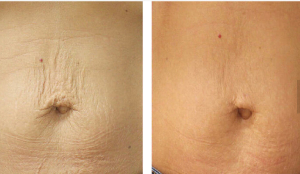 LipoFirm PRO Radiofrequency Face and Body Tightening