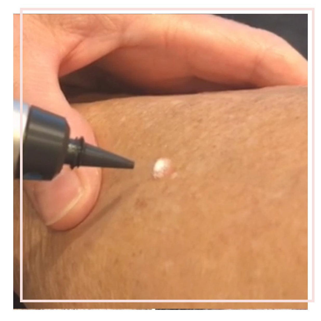 This image demonstrates mole, milia, or other lesion removal at our dermatology clinic in Beckenham. We serve patients from across Kent and Greater London including Petts Wood, Bromley, Sevenoaks, and Orpington.